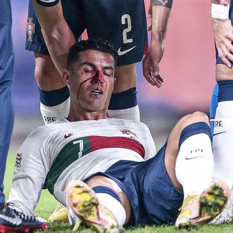 Ronaldonun burnu sındı -